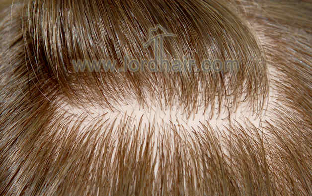 injected silicon hair replacement system injected silicon hair replacement system