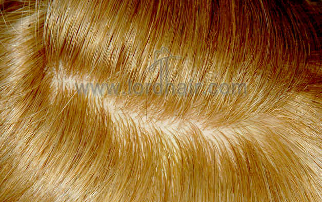 injected silicon hair replacement system injected silicon hair replacement system