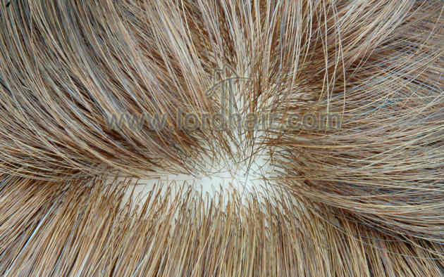 injected silicon hair replacement system injected silicon hair replacement system