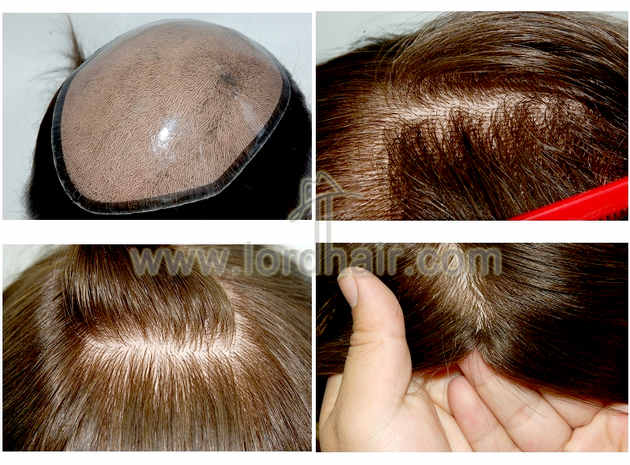 injected silicon hair replacement system injected silicon hair replacement system